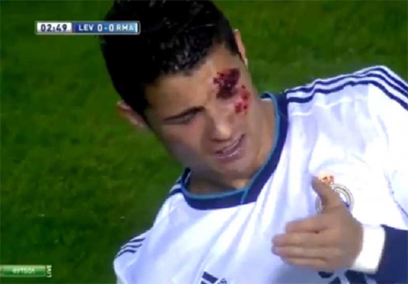 Криштиану Роналду получил травму в матче с "Леванте".