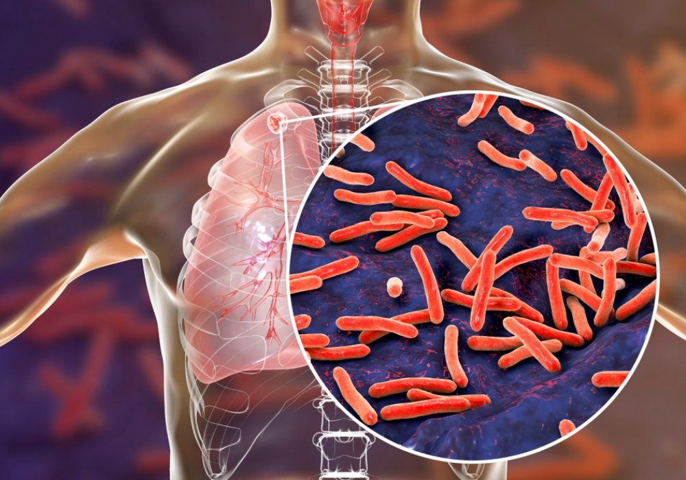 Туберкулез можно победить к 2045 году. Что для этого необходимо сделать
